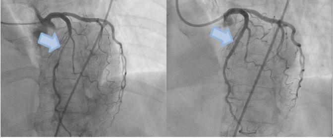 冠動脈左前下行枝の高度狭窄 ステント留置し拡張