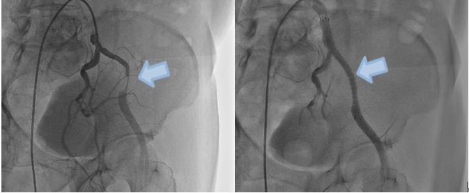 左外腸骨動脈の高度狭窄 ステント留置し拡張
