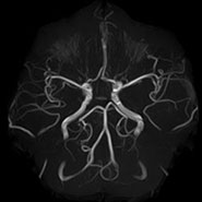 頭部MRA