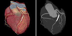 心臓CT3D画像