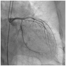 冠動脈造影検査（CAG）